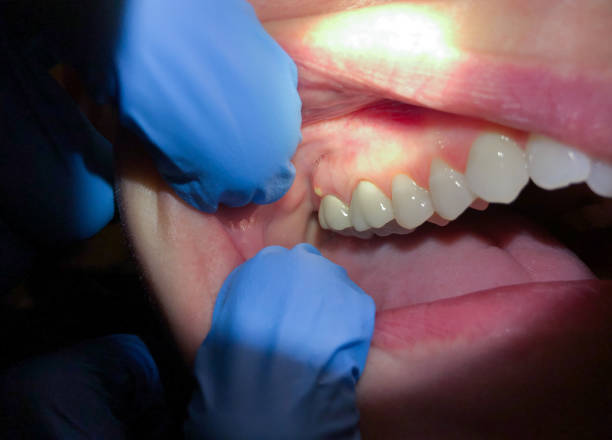 Best Emergency Gum Treatment in Miami, AZ